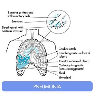 I 10 sintomi principali dell'ictus